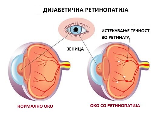 Дијабетична ретинопатија и ризици. Прегледај се!
